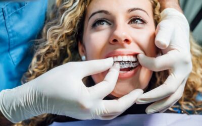 Invisalign 101: How Does Invisalign Work?