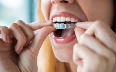 Common Questions About Invisalign