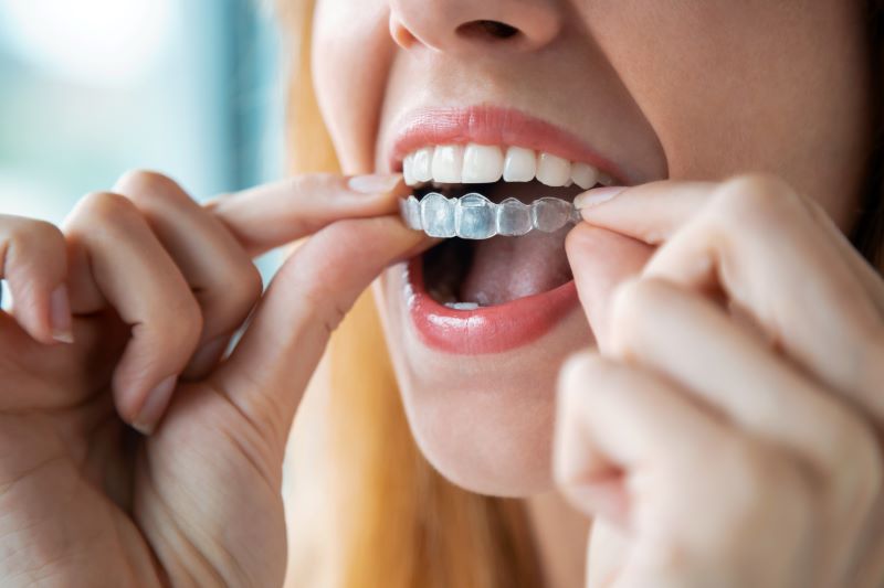 Common Questions About Invisalign